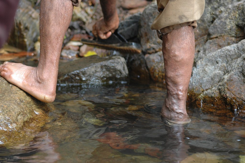 Mans legs with varicose veins